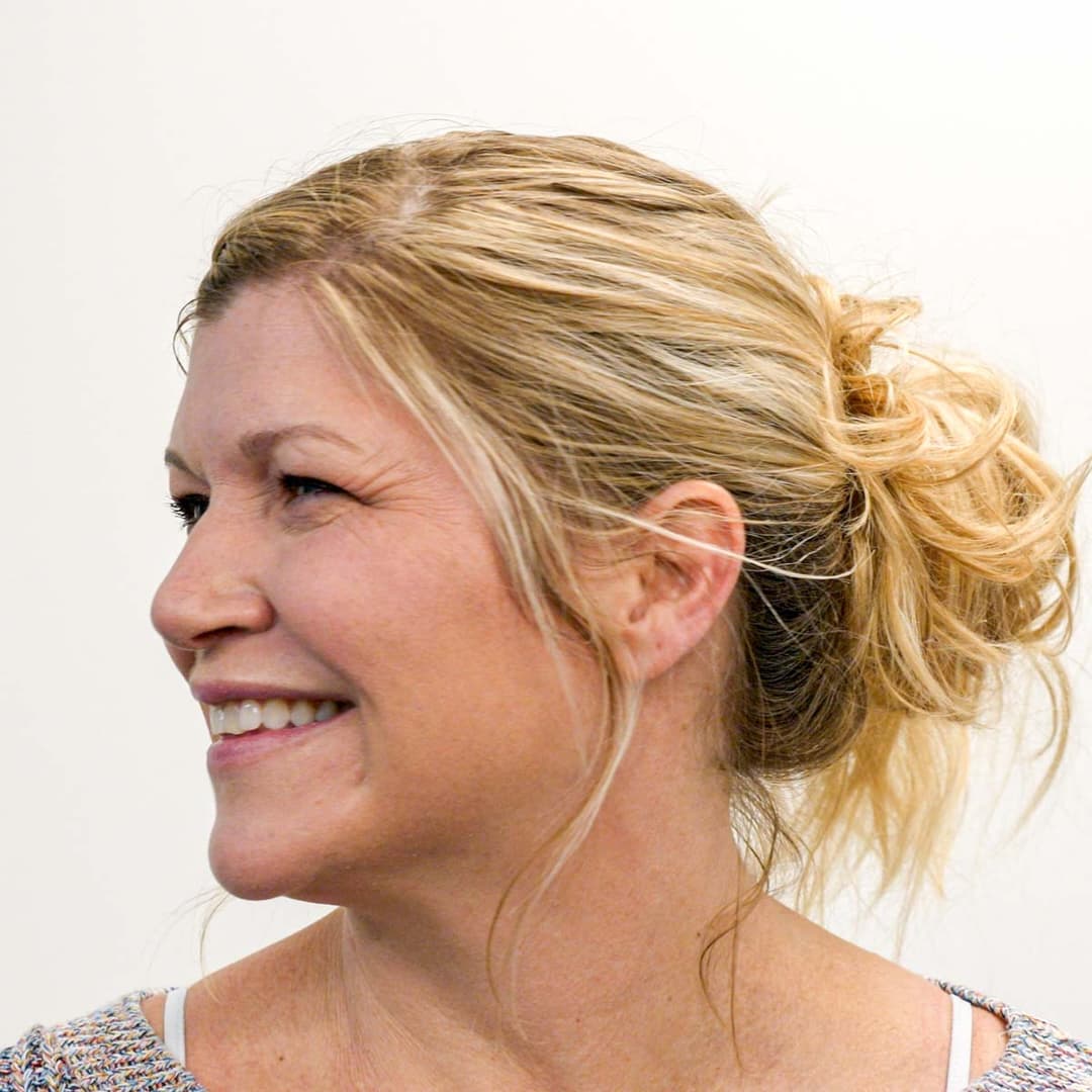 Before image 3 cc/syringes of Restylane in the tear troughs, nasal labial folds and jowls. Also, 2 cc/syringes of Restylane Lyft in the cheeks.