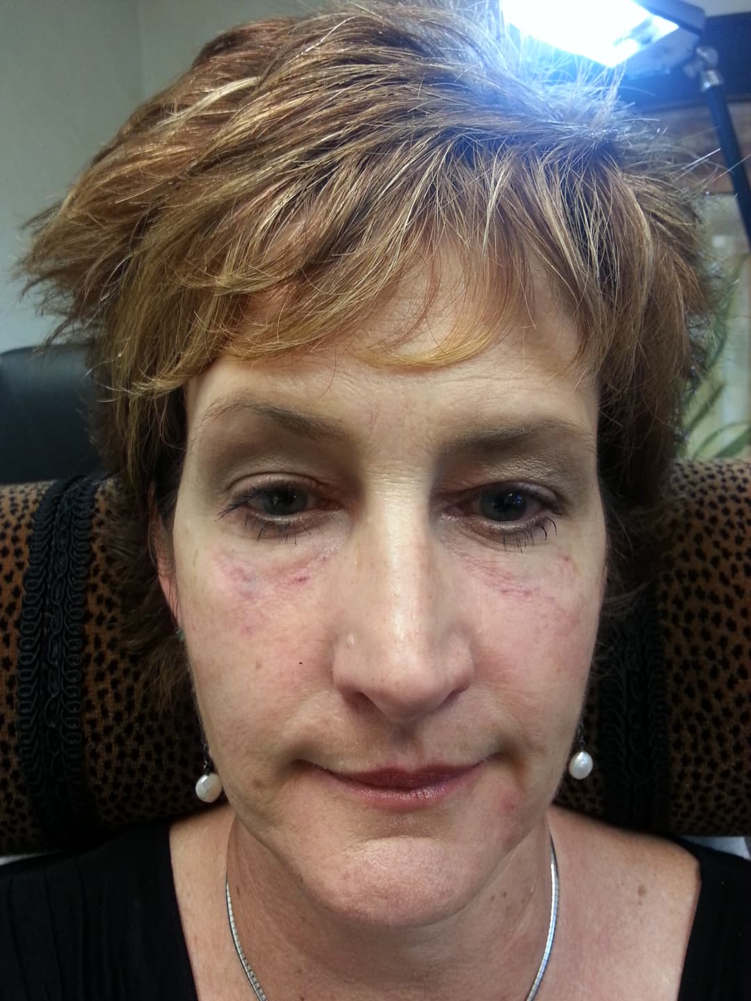 Before image After Injections