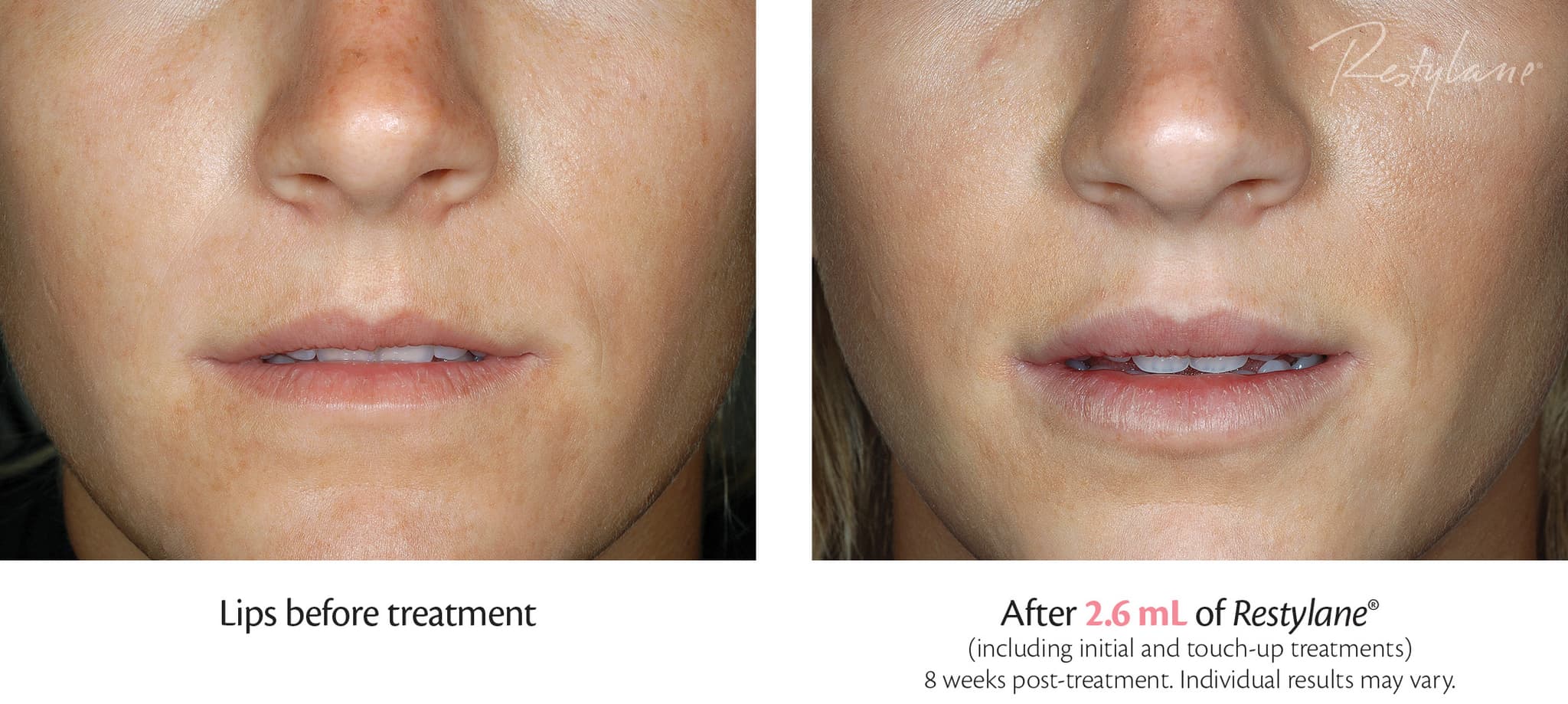 Before image Lips before and after 2.6ml of Restylane