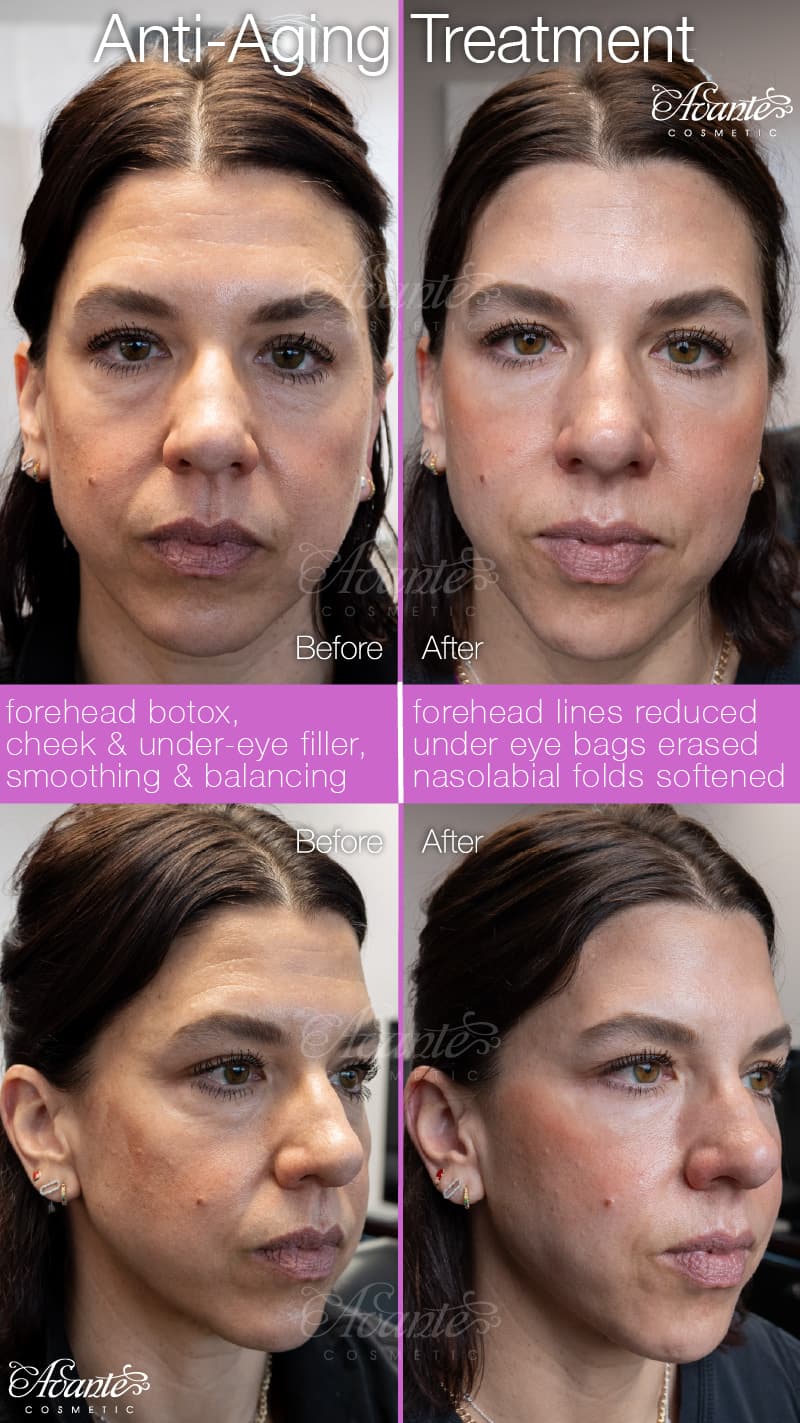 Before image Under Eye Cheek Filler