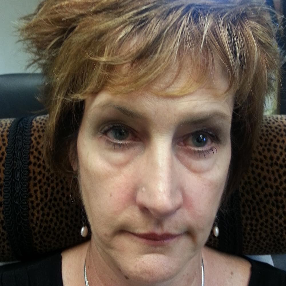 Before image Before 2 cc Restylane in tear troughs and 1 cc Restylane Lyft in cheeks