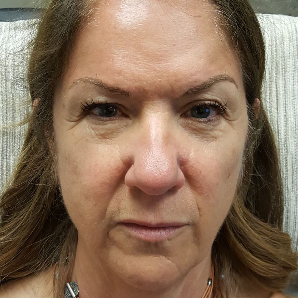 Before image Immediately before 6 syringes of Restylane Lyft