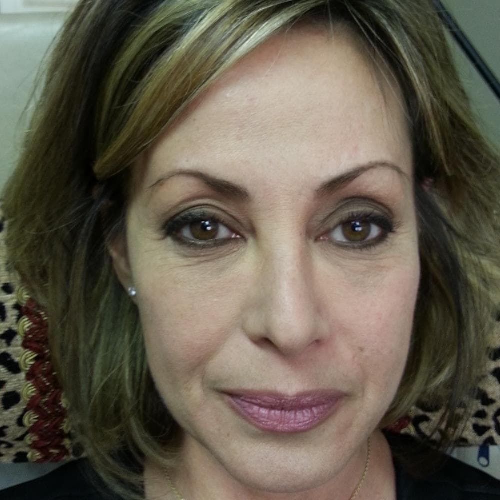 Before image Received 1 more cc Restylane in tear troughs (before)