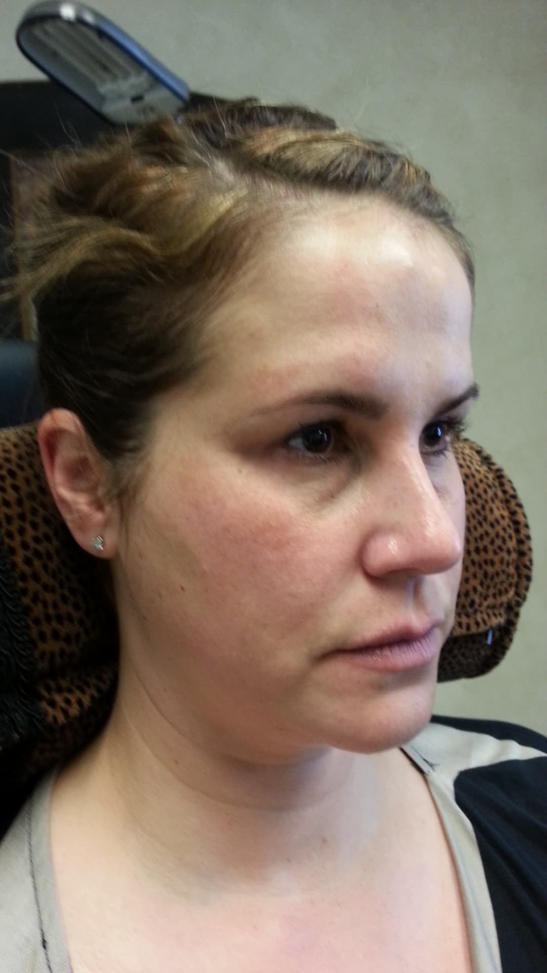 Before image Before 2 cc’s Restylane in the tear troughs and 3 cc’s Restylane Lyft in the cheeks, corners of the mouth, and jowls.