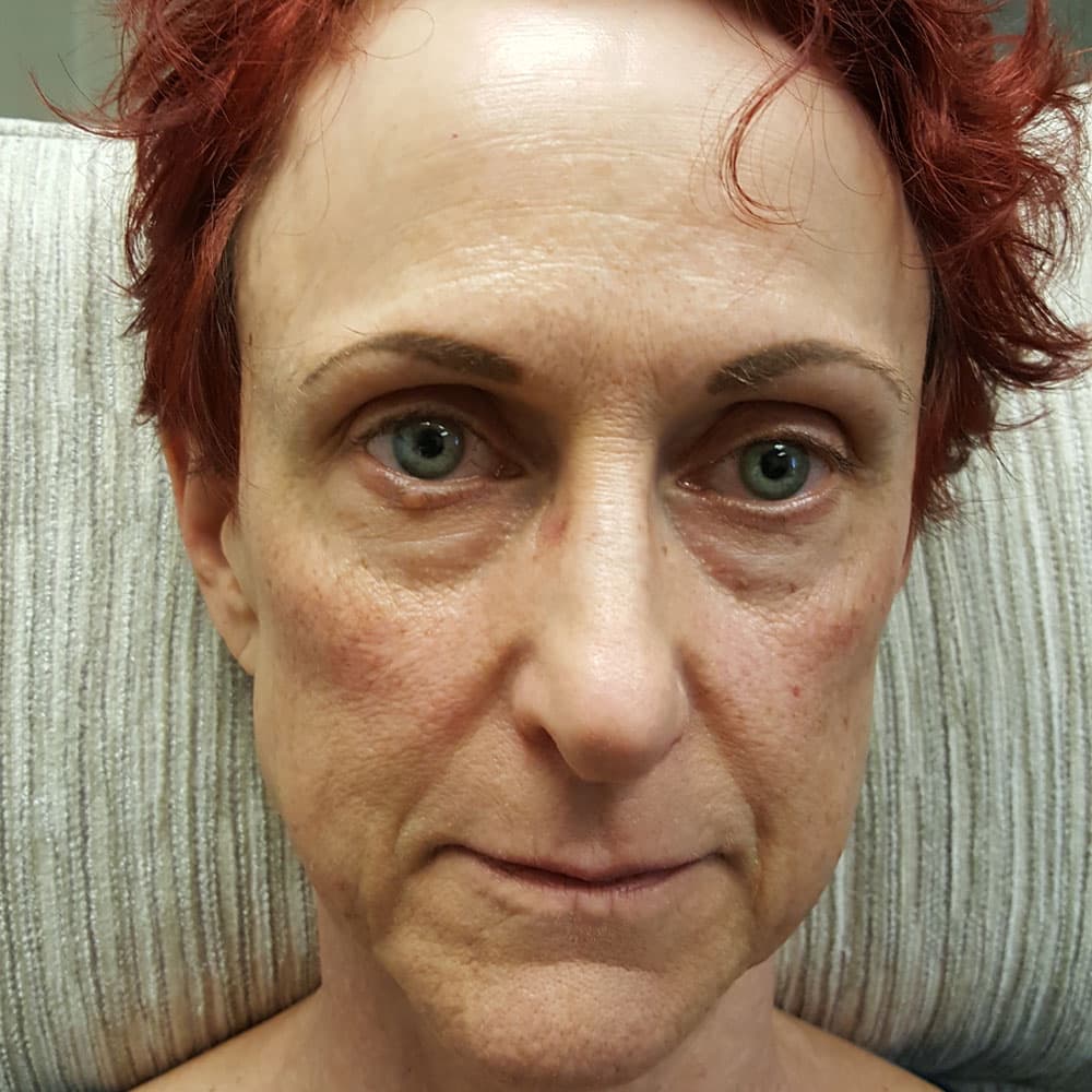 Before image Before 2 weeks of Restylane Lyft