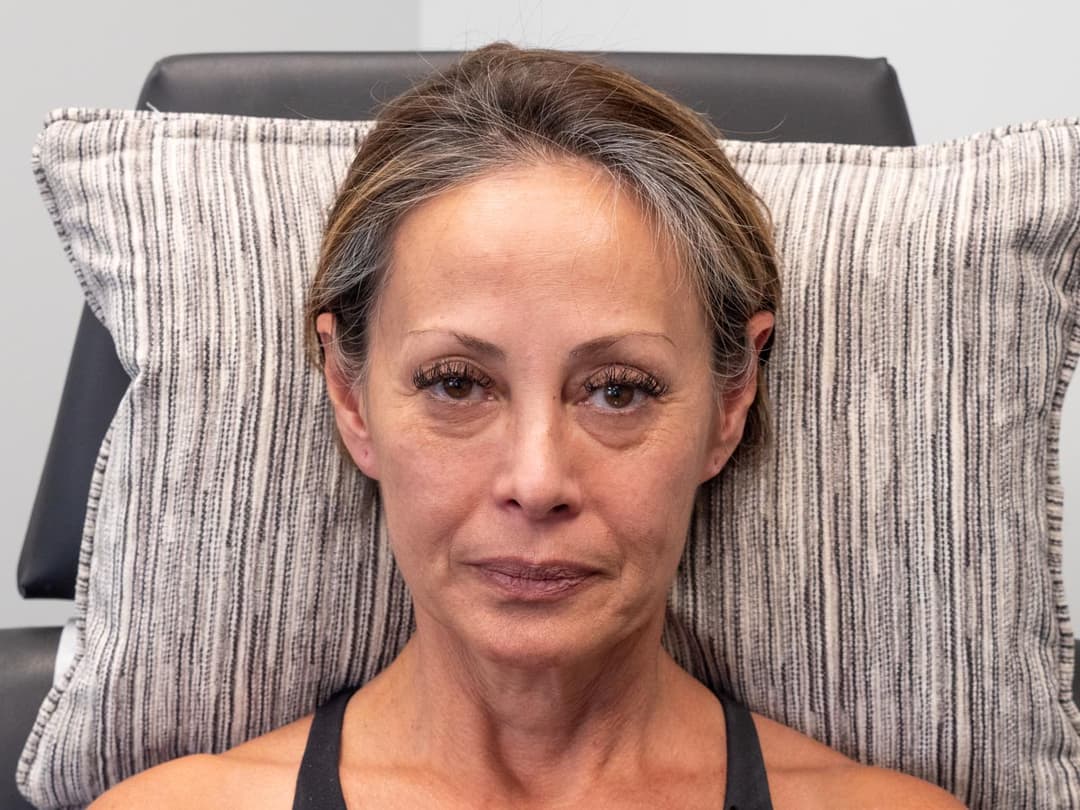 Before image Before 6cc of Restylane filler