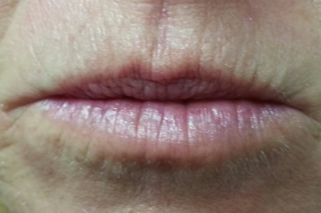 Before image Before 1cc Restylane