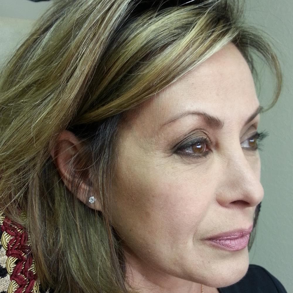 Before image Received 1 more cc Restylane in tear troughs (after)