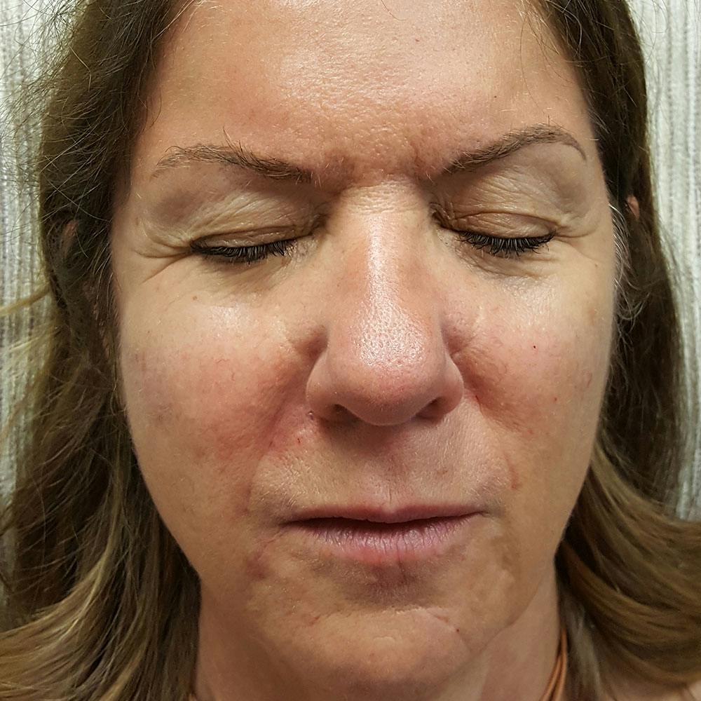 Before image Immediately after 6 syringes of Restylane Lyft