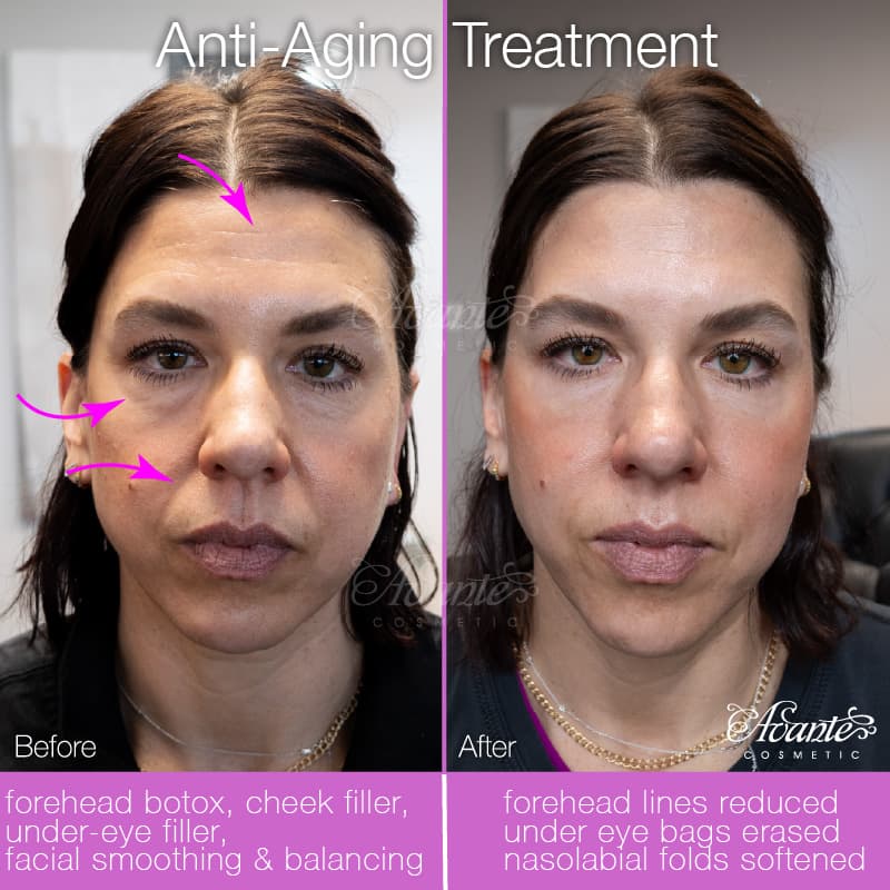 Before image Under-Eye & Cheek Filler: Before & After
